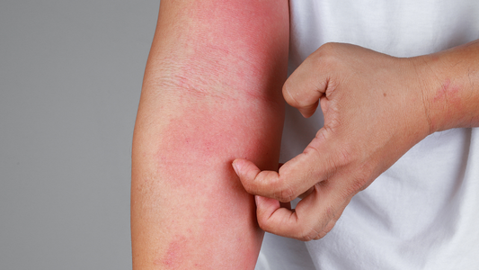 L-Theanine: A Natural Solution for Atopic Dermatitis Relief